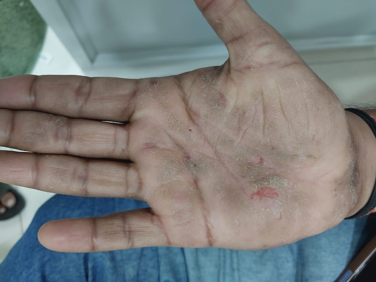 After treatment