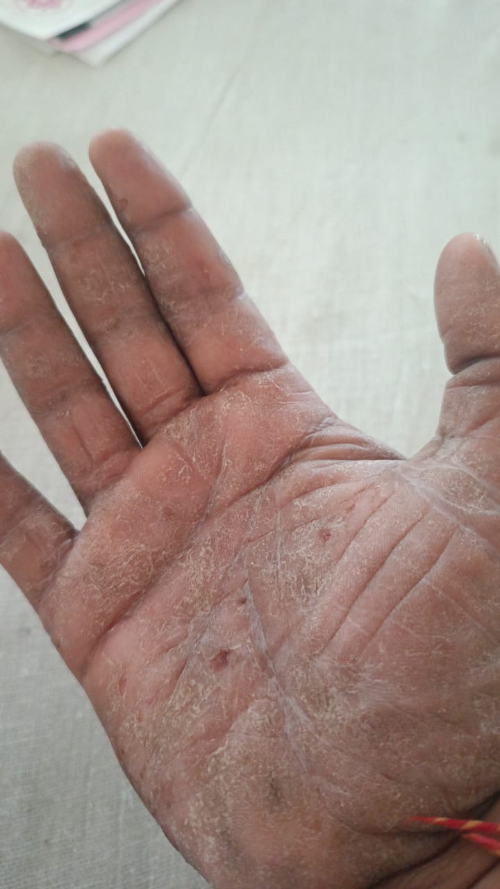 Before treatment