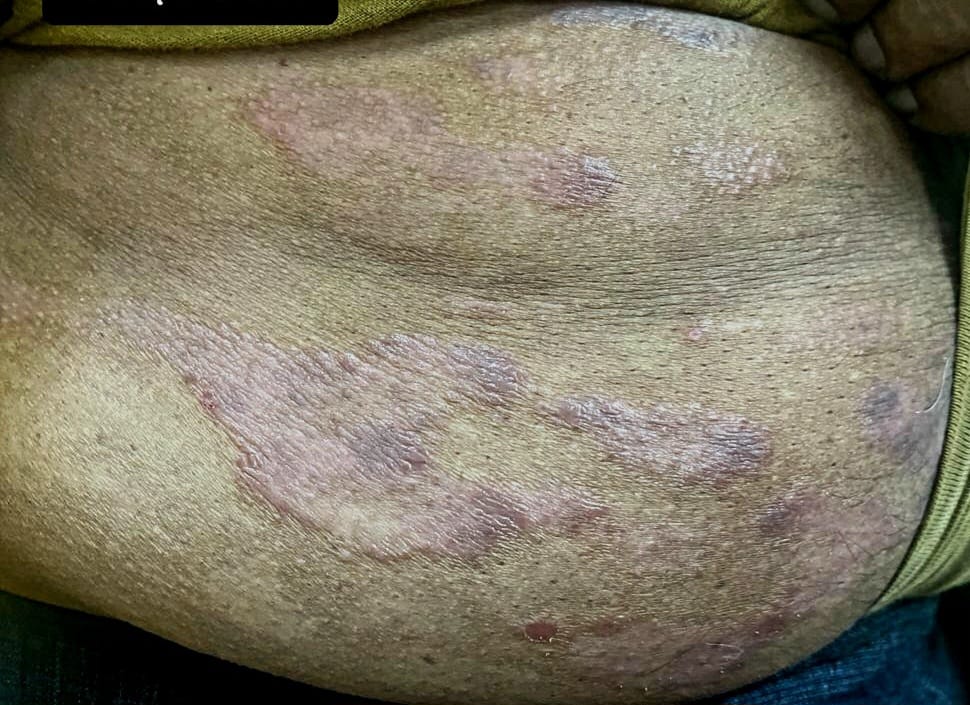 Before treatment